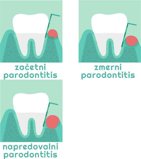 paradontitis primerjava